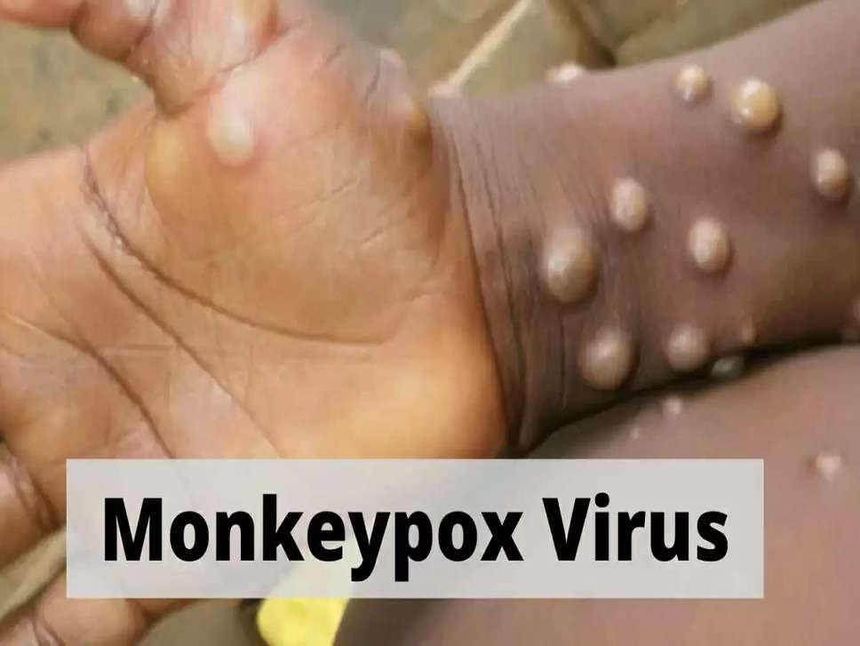 Monkeypox&nbsp;को लेकर UP सरकार ने जारी किया अलर्ट, ऐसे लोगों के लिए आइसोलेशन जरूरी