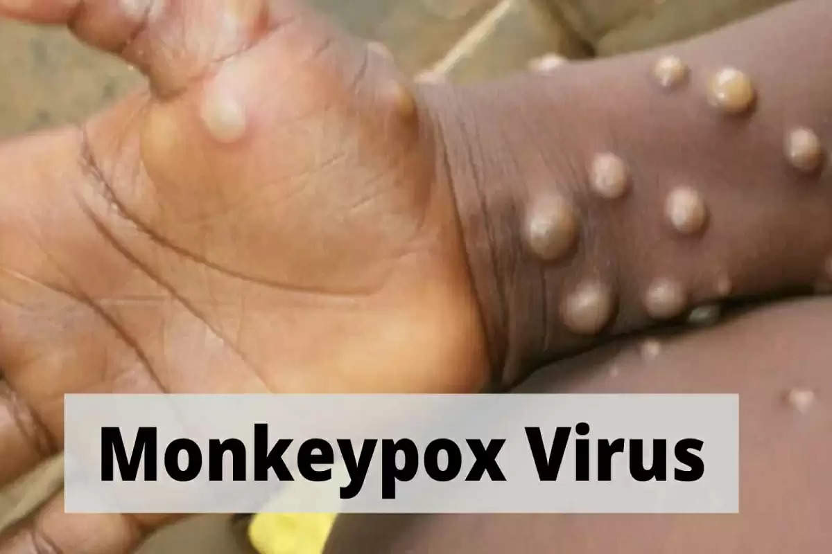 Monkeypox को लेकर UP सरकार ने जारी किया अलर्ट, ऐसे लोगों के लिए आइसोलेशन जरूरी